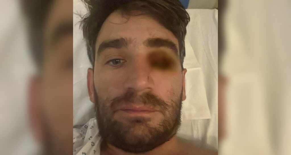 Hombre pierde un ojo tras explosión de pirotecnia en fiesta de Año Nuevo