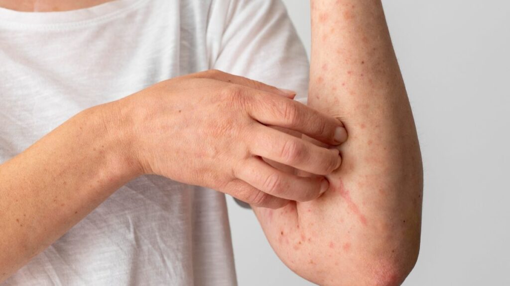 Nuevo León Reporta 33 Casos de Sarampión en 2026: ¿Es una Epidemia en Puerta?