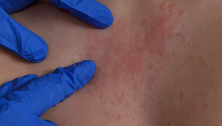 Cinco casos de sarampión confirmados en Centros de Detención de Nuevo México