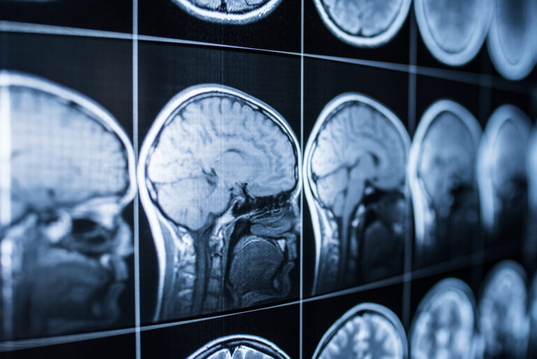 Lesiones Cerebrales en Colorado: Medio Millón de Residentes Afectados y Nueva Herramienta de Evaluación